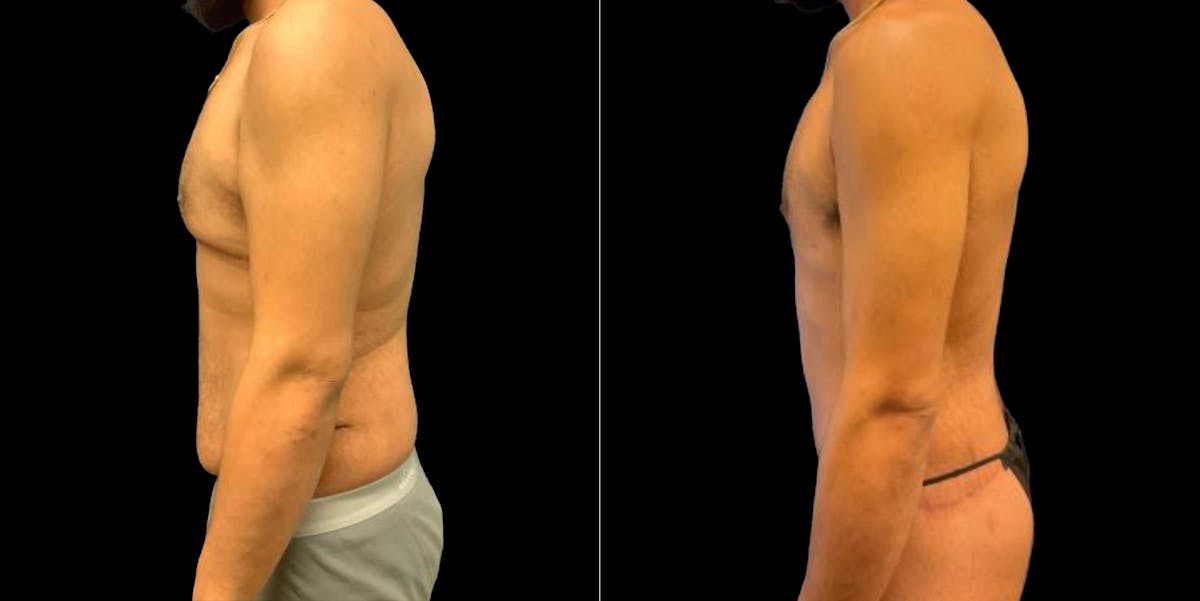 Abdominoplasty Before & After Gallery - Patient 809044 - Image 3
