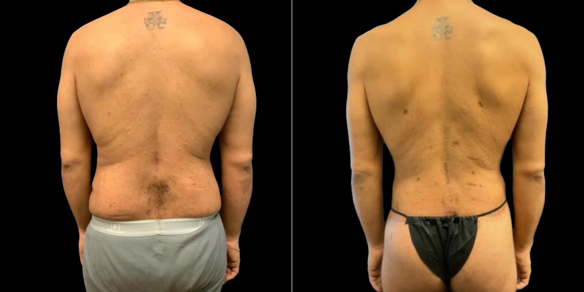 Abdominoplasty Before & After Gallery - Patient 809044 - Image 4