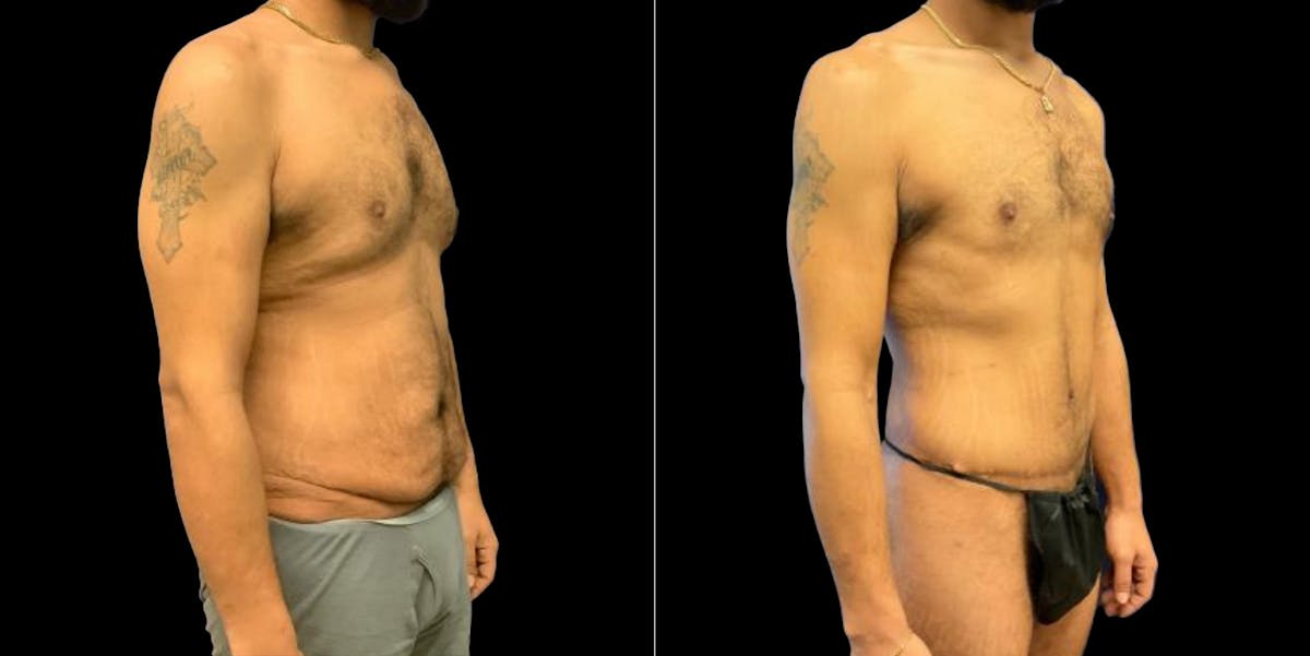 Abdominoplasty Before & After Gallery - Patient 809044 - Image 5