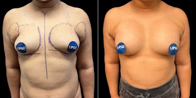 Breast Augmentation Before & After Gallery - Patient 419538 - Image 1