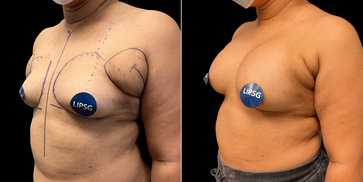 Breast Augmentation Before & After Gallery - Patient 419538 - Image 3