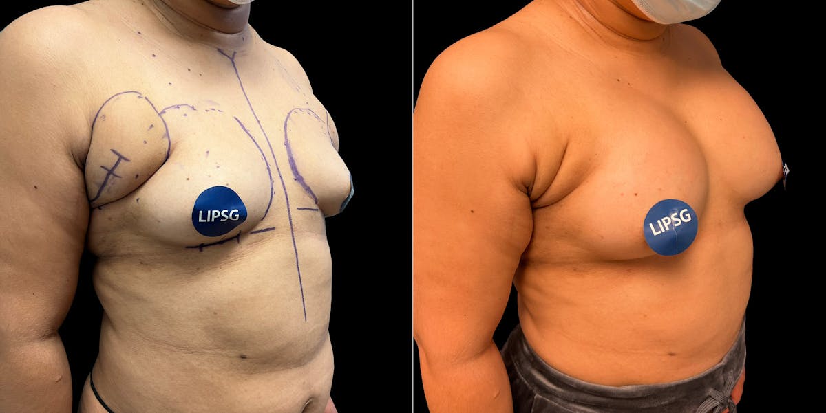 Breast Augmentation Before & After Gallery - Patient 419538 - Image 2