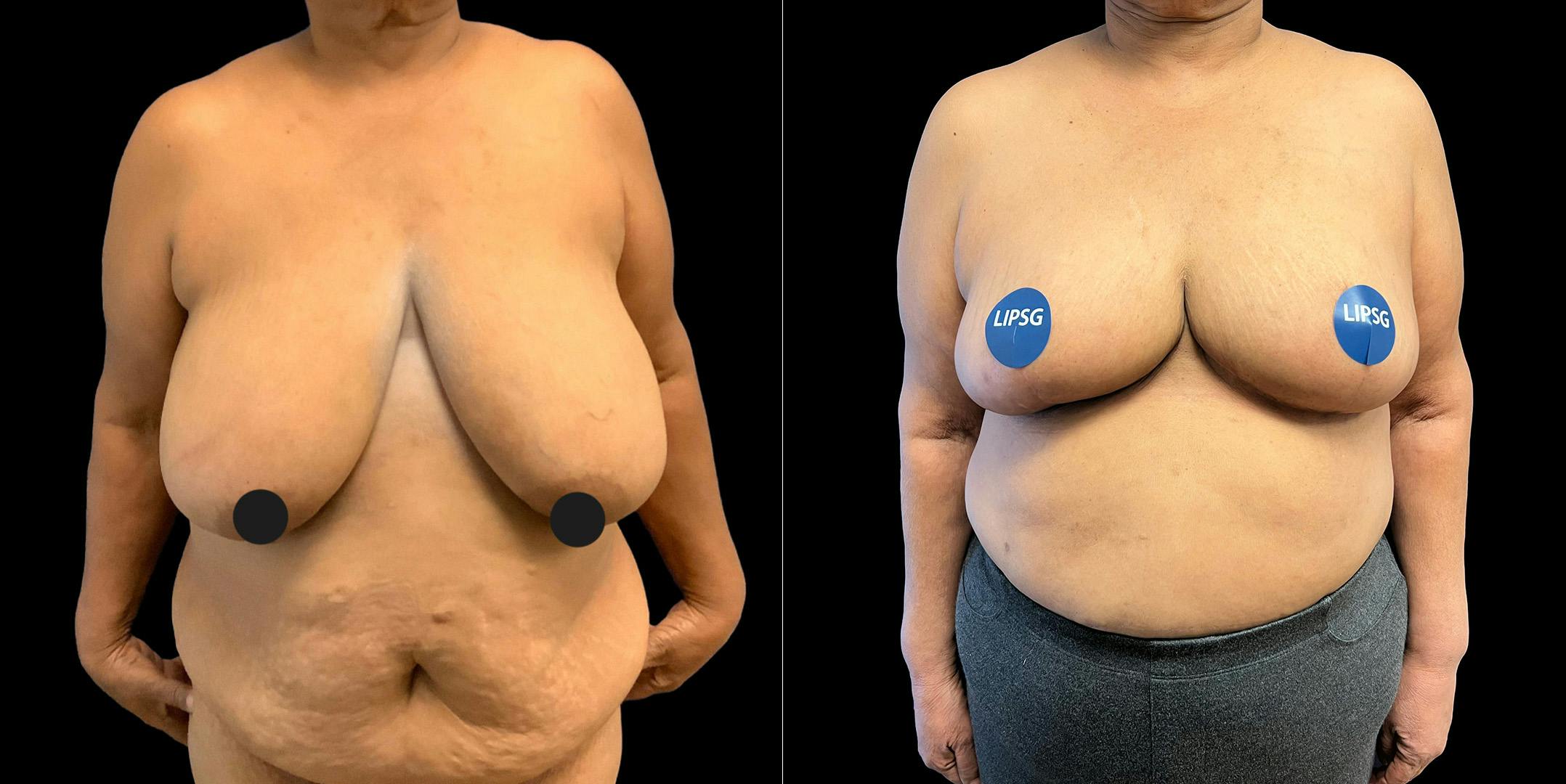 Breast Reduction Before & After Gallery - Patient 320984 - Image 3
