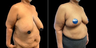 Breast Reduction Before & After Gallery - Patient 320984 - Image 1