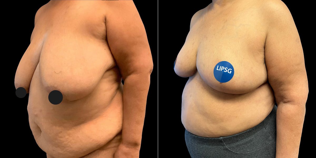 Breast Reduction Before & After Gallery - Patient 320984 - Image 2