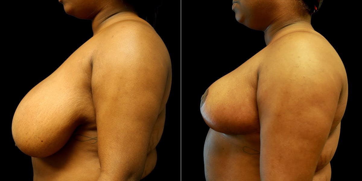 Breast Reduction Before & After Gallery - Patient 776206 - Image 3