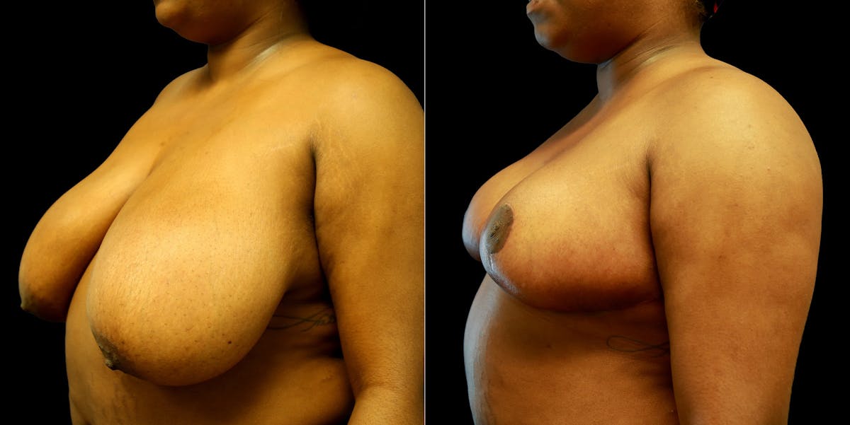 Breast Reduction Before & After Gallery - Patient 776206 - Image 2