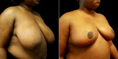 Breast Reduction Before & After Gallery - Patient 776206 - Image 1