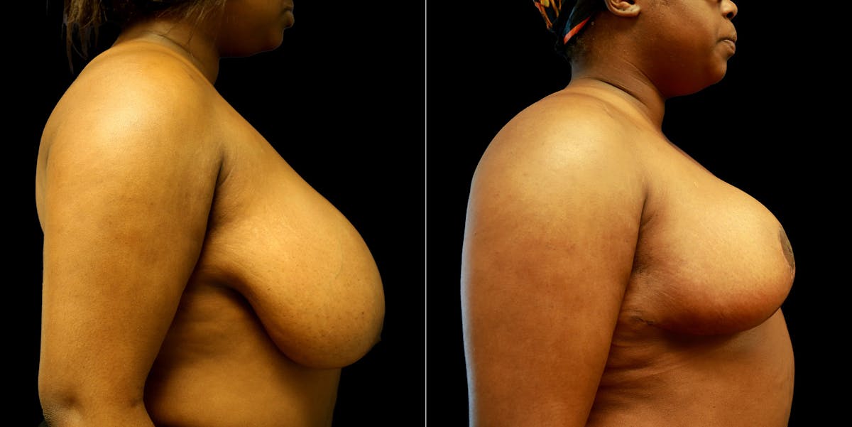 Breast Reduction Before & After Gallery - Patient 776206 - Image 4