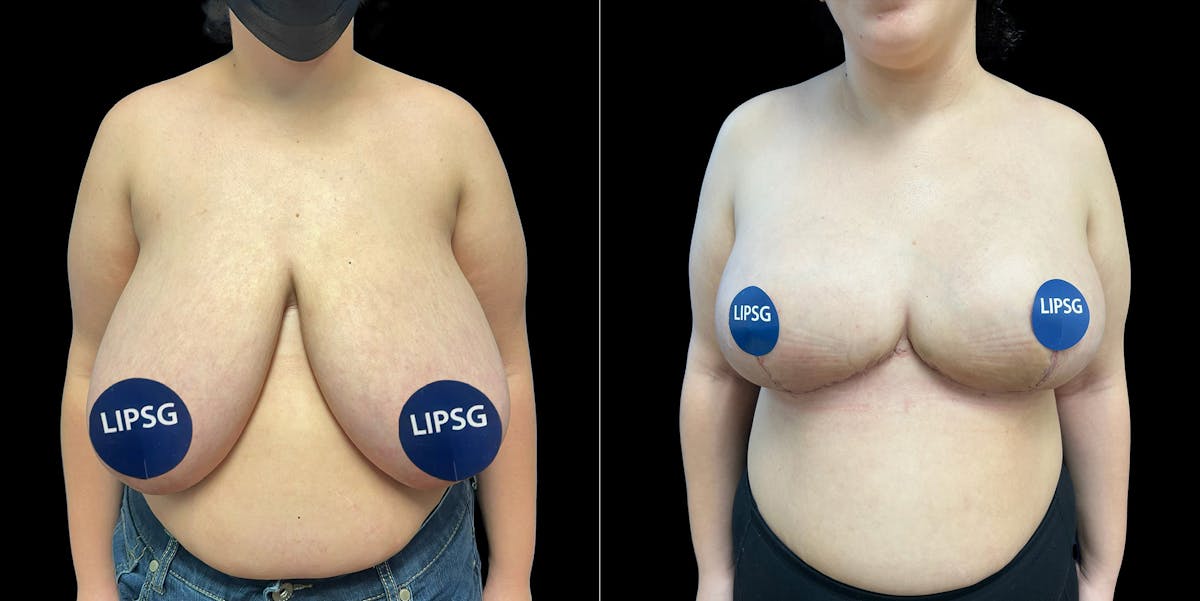Breast Reduction Before & After Gallery - Patient 231956 - Image 2