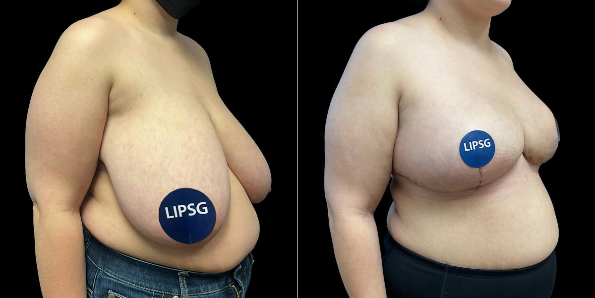 Breast Reduction Before & After Gallery - Patient 231956 - Image 1