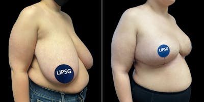 Breast Reduction Before & After Gallery - Patient 231956 - Image 1