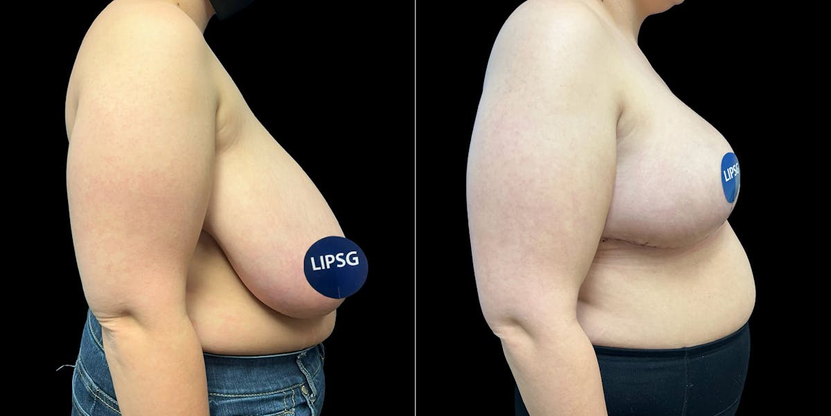 Breast Reduction Before & After Gallery - Patient 231956 - Image 3