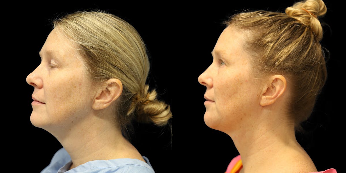 Short Scar Neck Lift Before & After Gallery - Patient 387523 - Image 3
