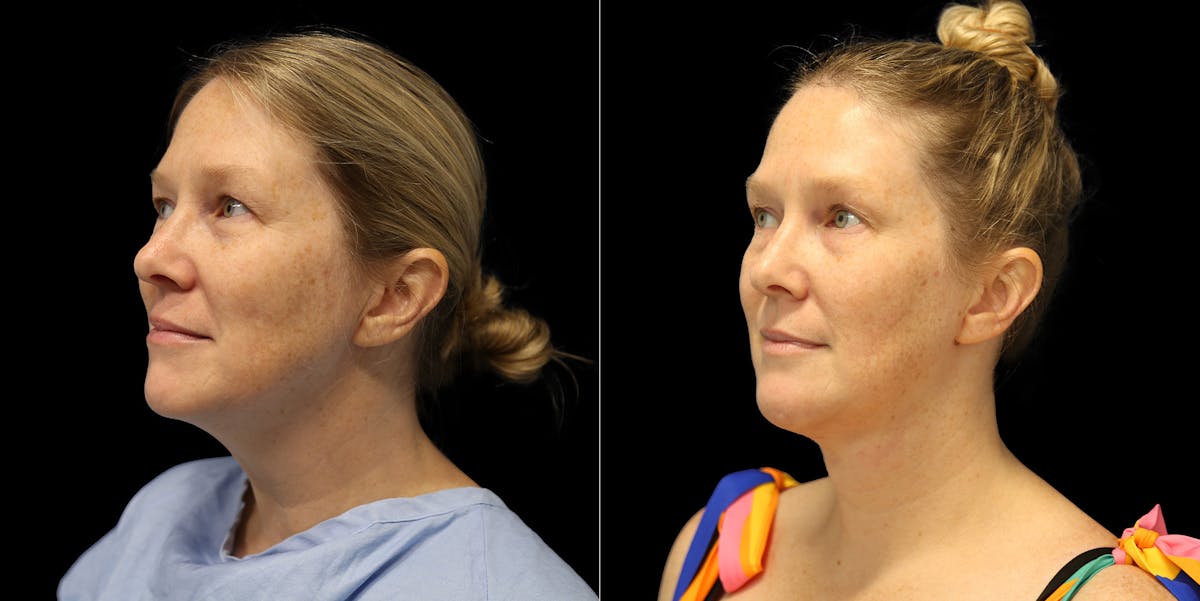 Short Scar Neck Lift Before & After Gallery - Patient 387523 - Image 4