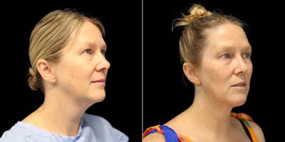 Short Scar Neck Lift Before & After Gallery - Patient 387523 - Image 1
