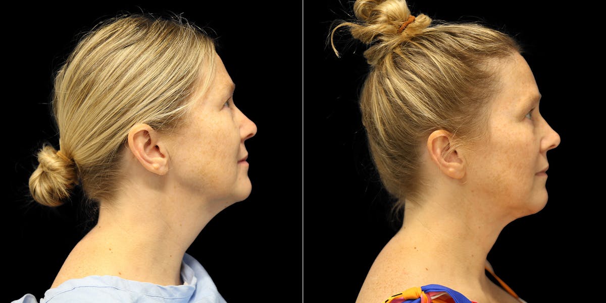 Short Scar Neck Lift Before & After Gallery - Patient 387523 - Image 2
