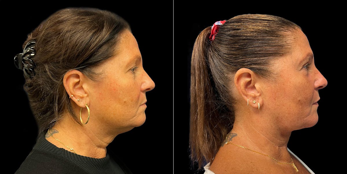 Short Scar Neck Lift Before & After Gallery - Patient 131582 - Image 3