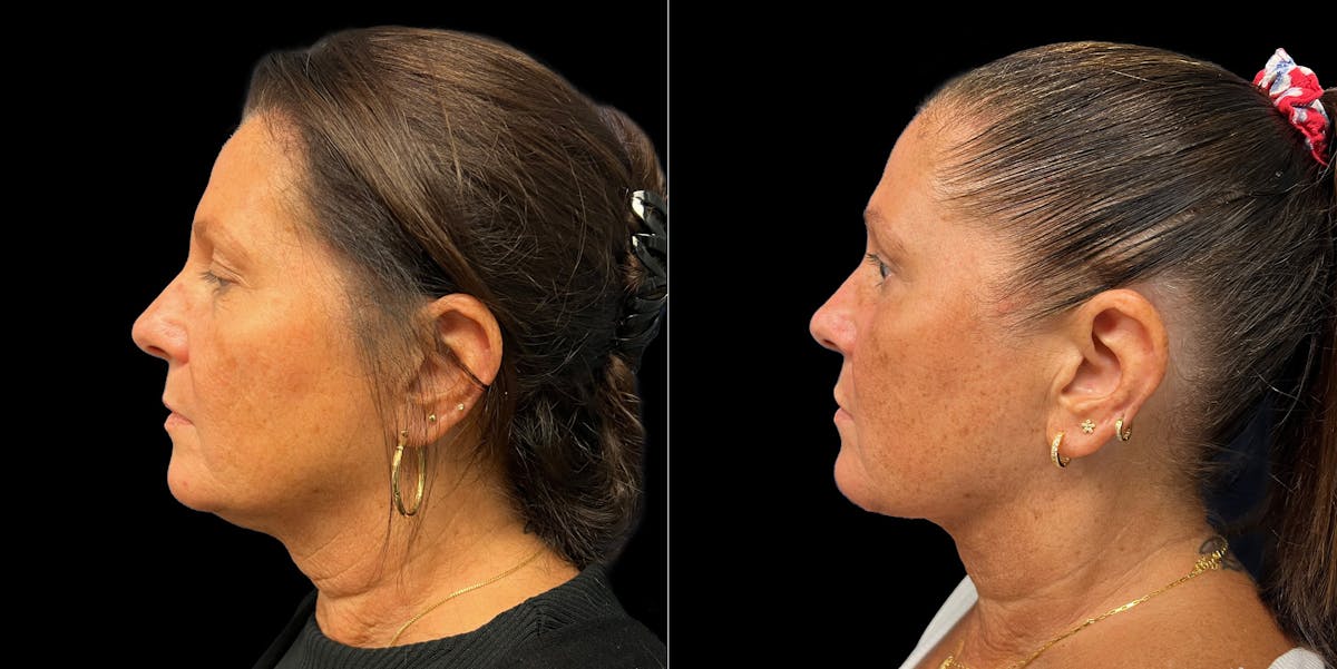Short Scar Neck Lift Before & After Gallery - Patient 131582 - Image 5