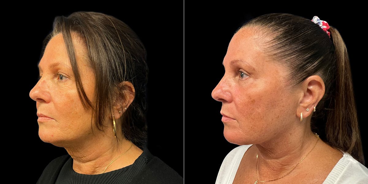 Short Scar Neck Lift Before & After Gallery - Patient 131582 - Image 6