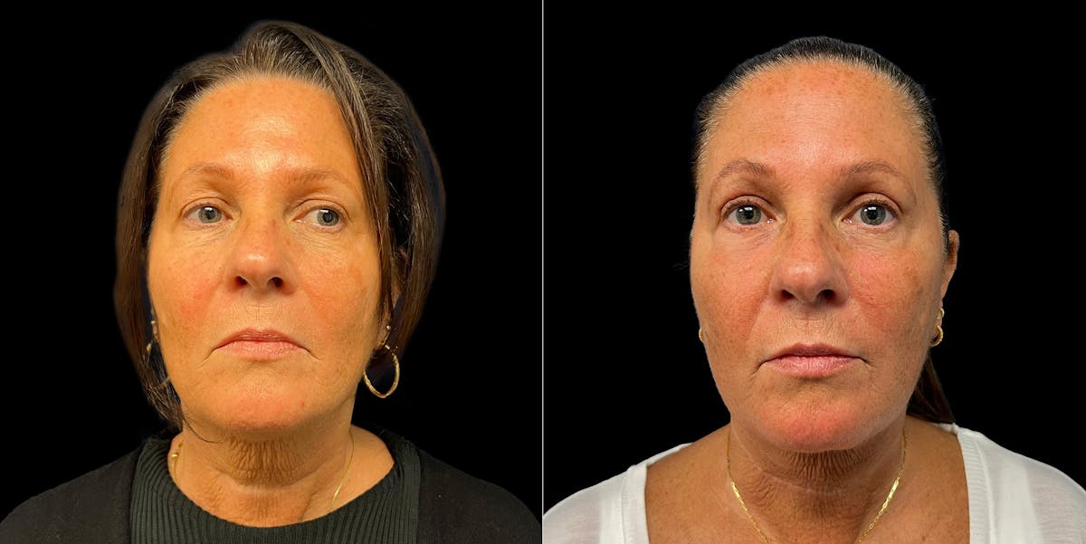 Short Scar Neck Lift Before & After Gallery - Patient 131582 - Image 2