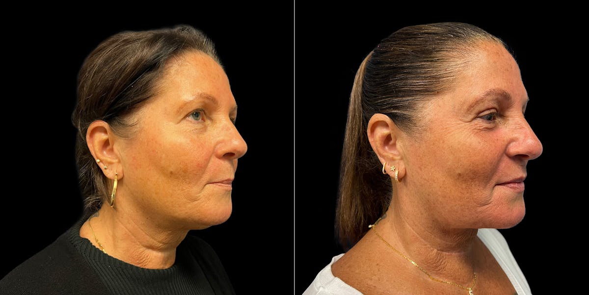 Short Scar Neck Lift Before & After Gallery - Patient 131582 - Image 1