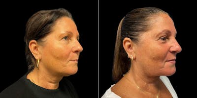 Short Scar Neck Lift Before & After Gallery - Patient 131582 - Image 1