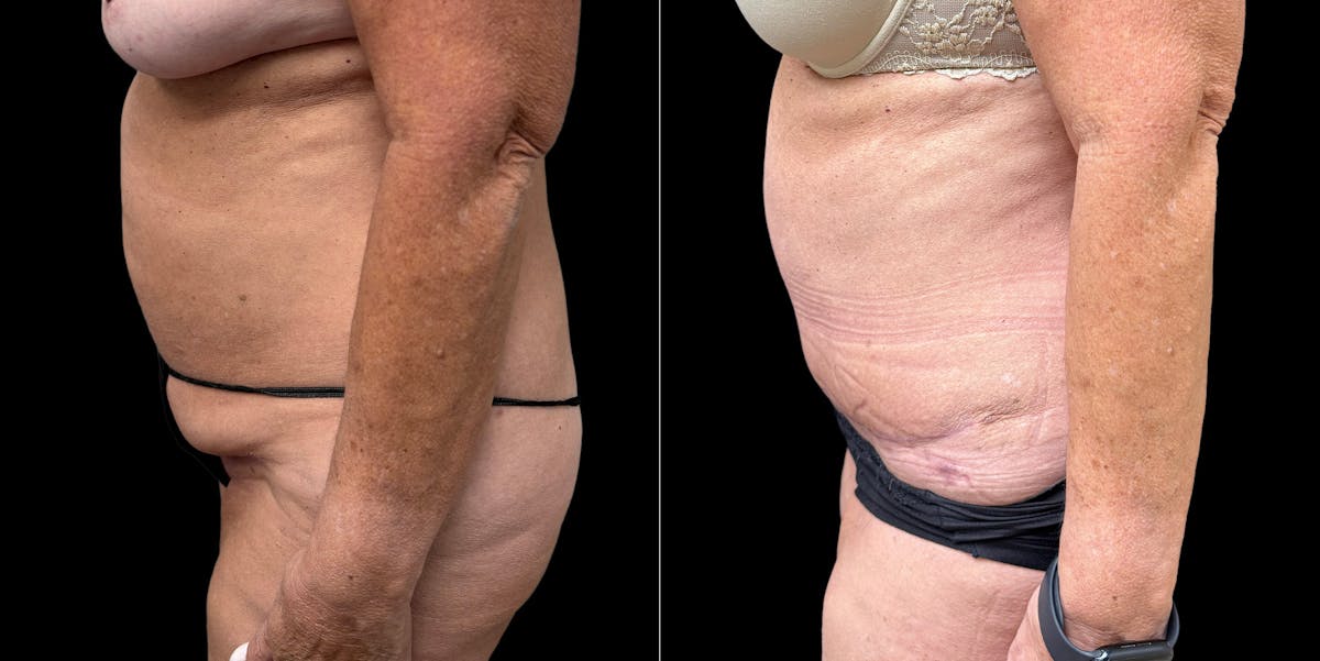 Liposuction Before & After Gallery - Patient 350662 - Image 5