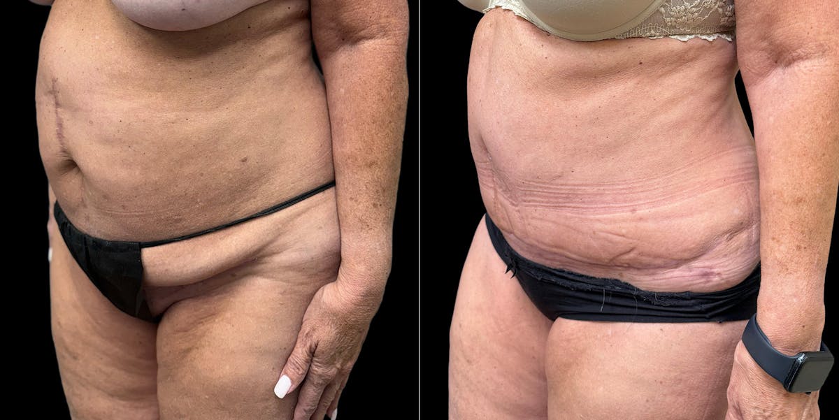 Liposuction Before & After Gallery - Patient 350662 - Image 4