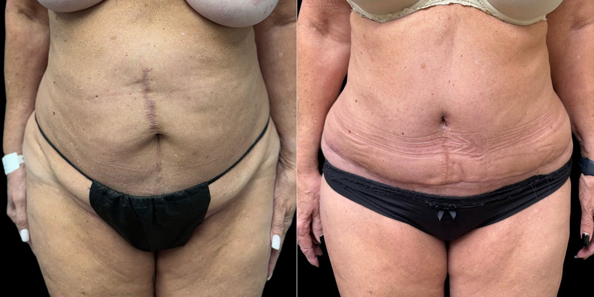 Liposuction Before & After Gallery - Patient 350662 - Image 1
