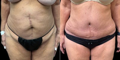 Liposuction Before & After Gallery - Patient 350662 - Image 1
