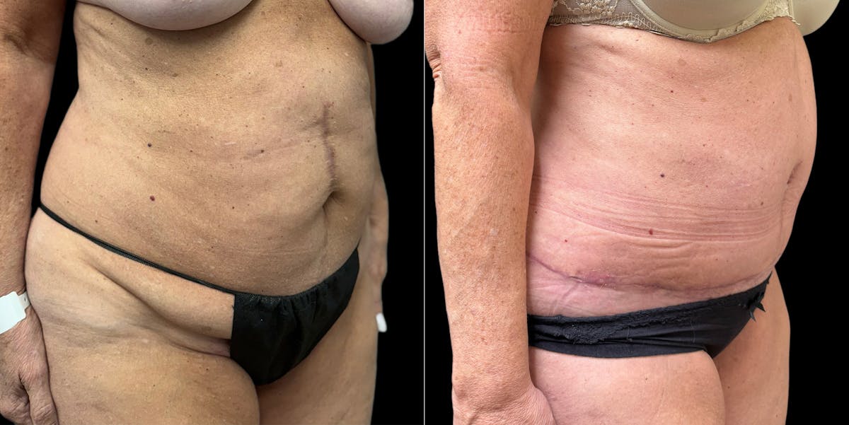 Liposuction Before & After Gallery - Patient 350662 - Image 3