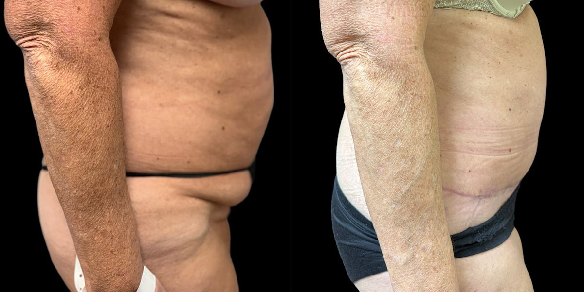 Liposuction Before & After Gallery - Patient 350662 - Image 2