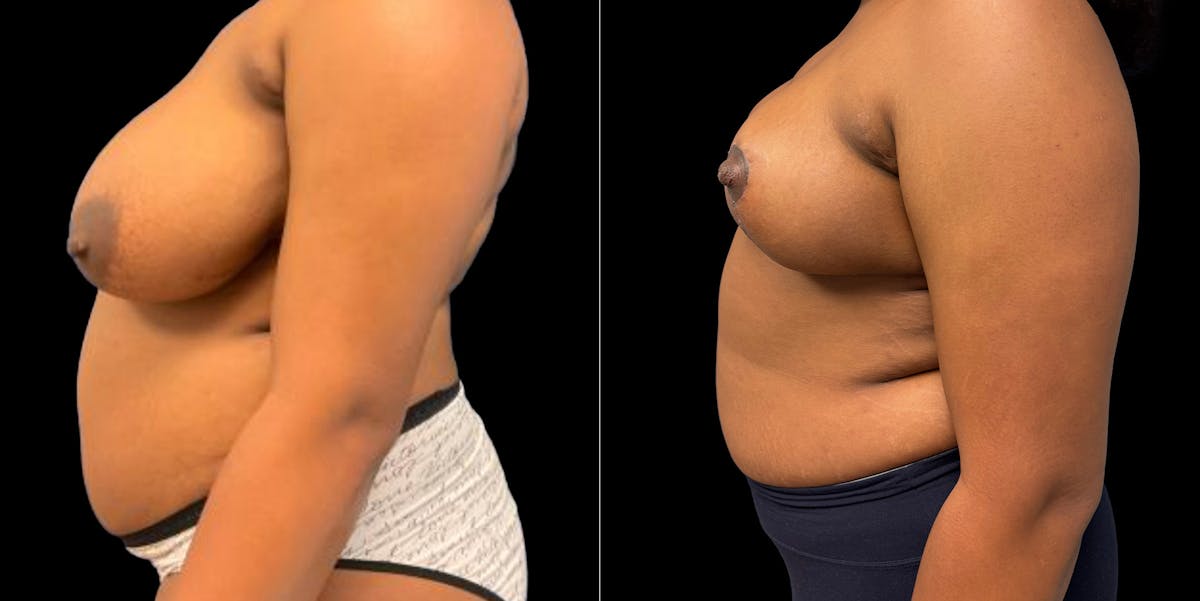 Breast Reduction Before & After Gallery - Patient 633632 - Image 5