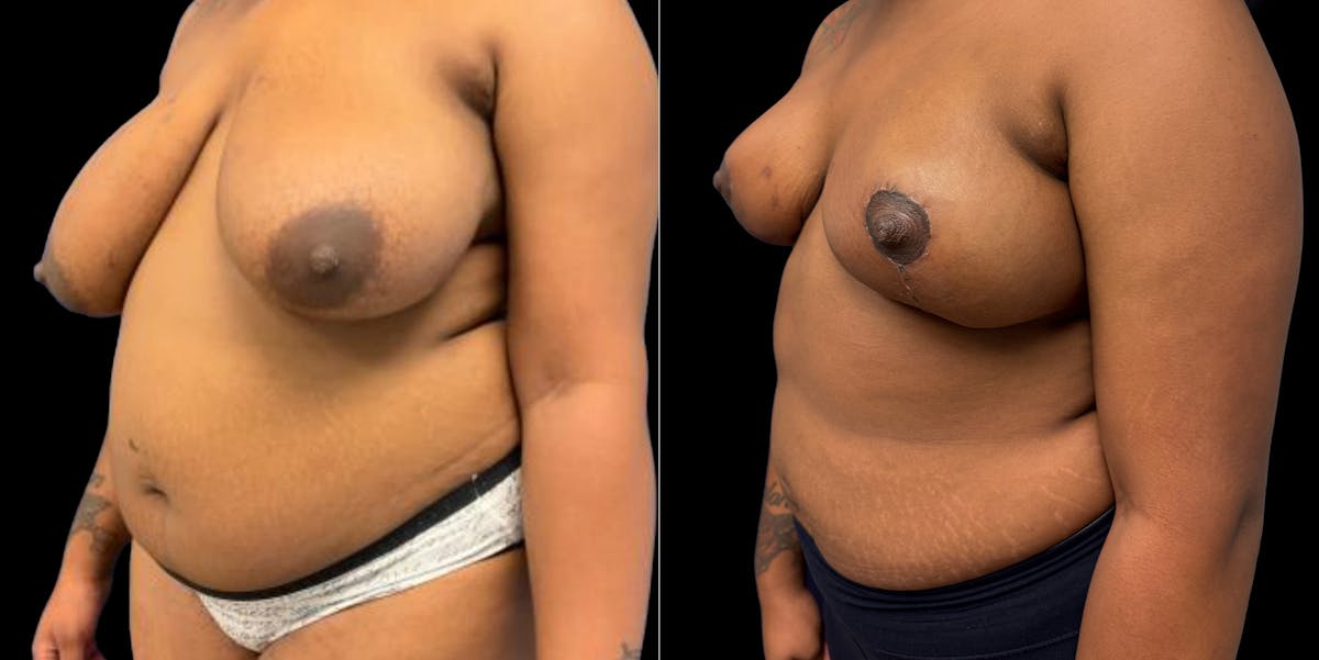 Breast Reduction Before & After Gallery - Patient 633632 - Image 4