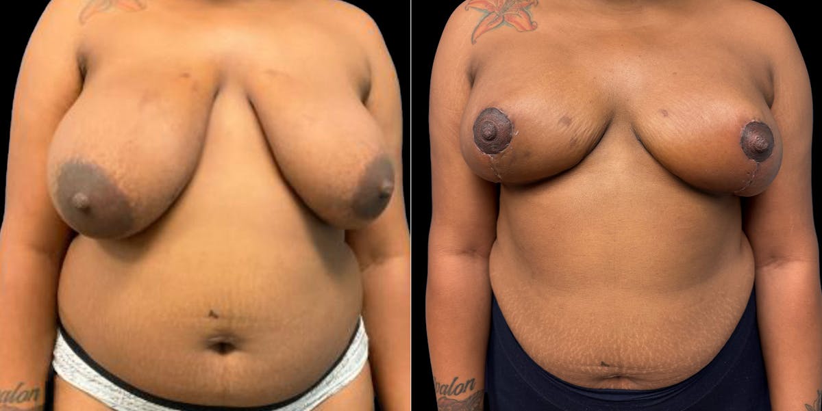 Breast Reduction Before & After Gallery - Patient 633632 - Image 1