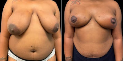 Breast Reduction Before & After Gallery - Patient 633632 - Image 1