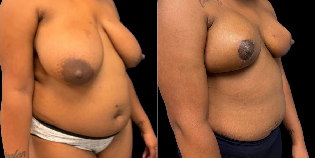 Breast Reduction Before & After Gallery - Patient 633632 - Image 2