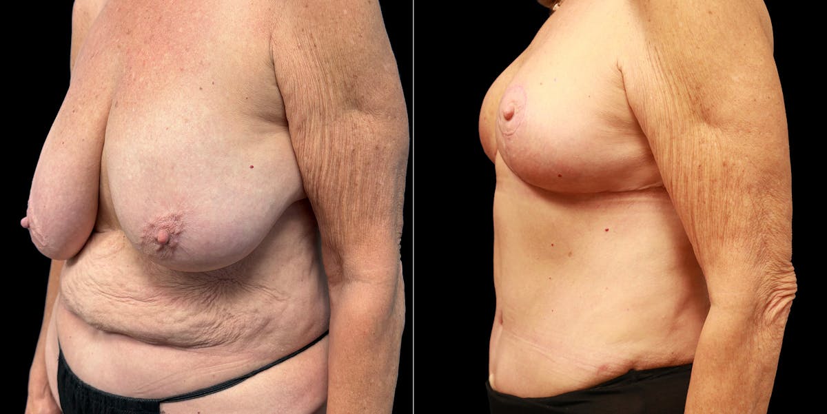 Abdominoplasty Before & After Gallery - Patient 336170 - Image 5