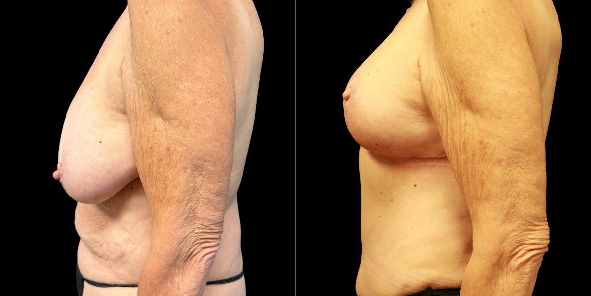 Abdominoplasty Before & After Gallery - Patient 336170 - Image 4