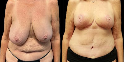 Breast Reduction Before & After Gallery - Patient 120136 - Image 1