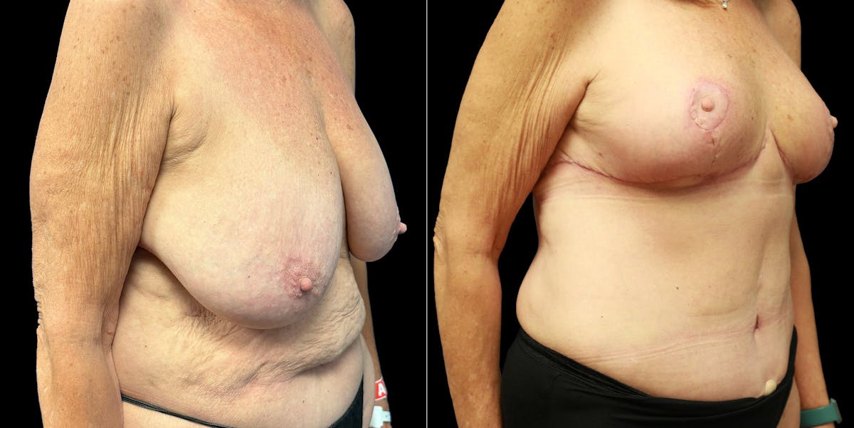 Abdominoplasty Before & After Gallery - Patient 336170 - Image 2