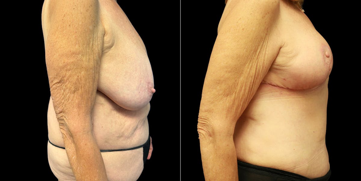 Abdominoplasty Before & After Gallery - Patient 336170 - Image 3