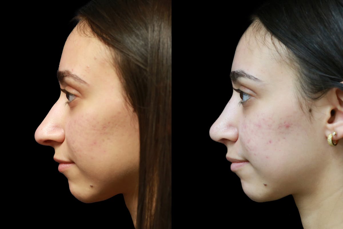Rhinoplasty Before & After Gallery - Patient 317097 - Image 6