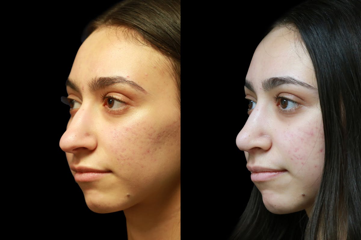 Rhinoplasty Before & After Gallery - Patient 317097 - Image 5