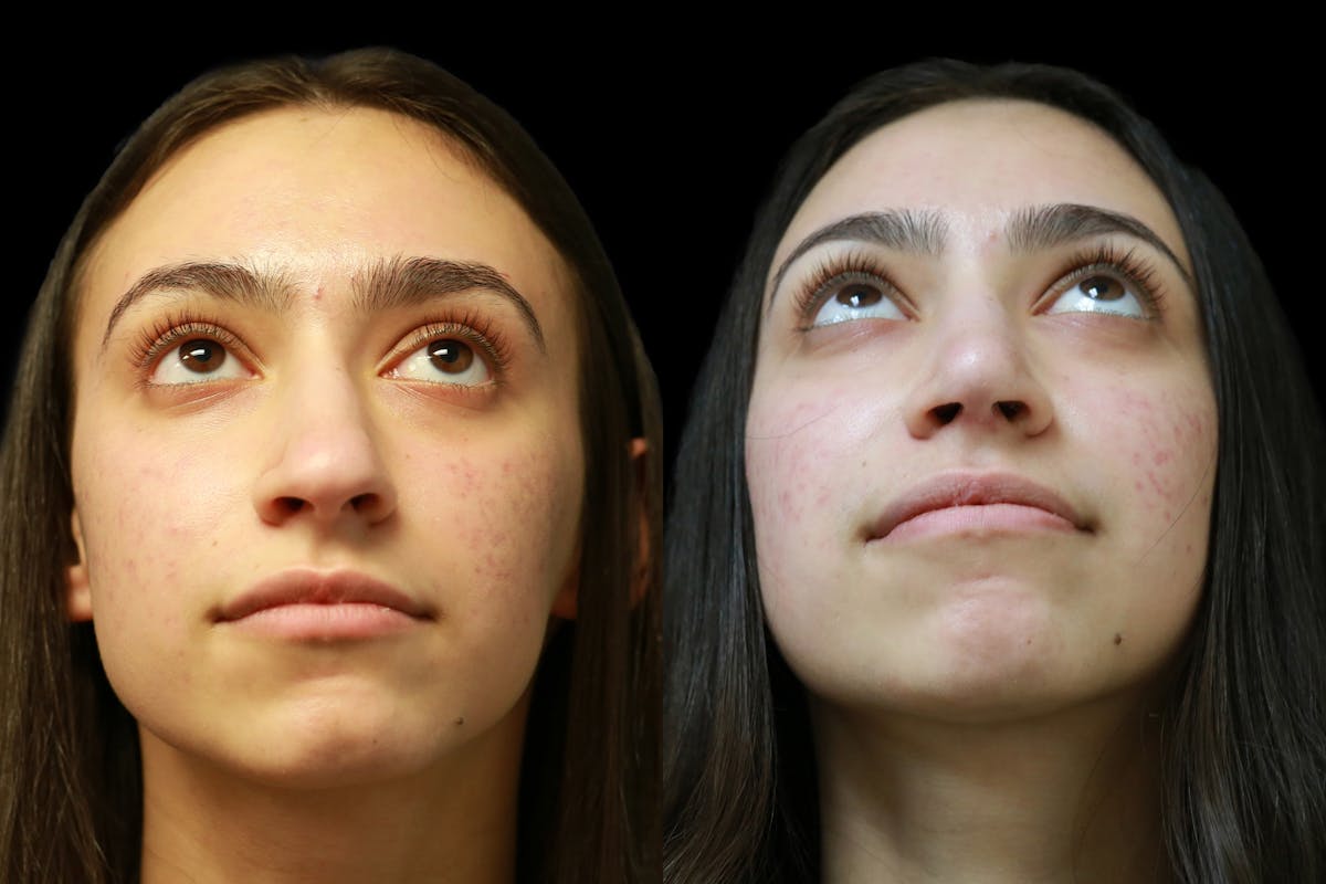 Rhinoplasty Before & After Gallery - Patient 317097 - Image 4