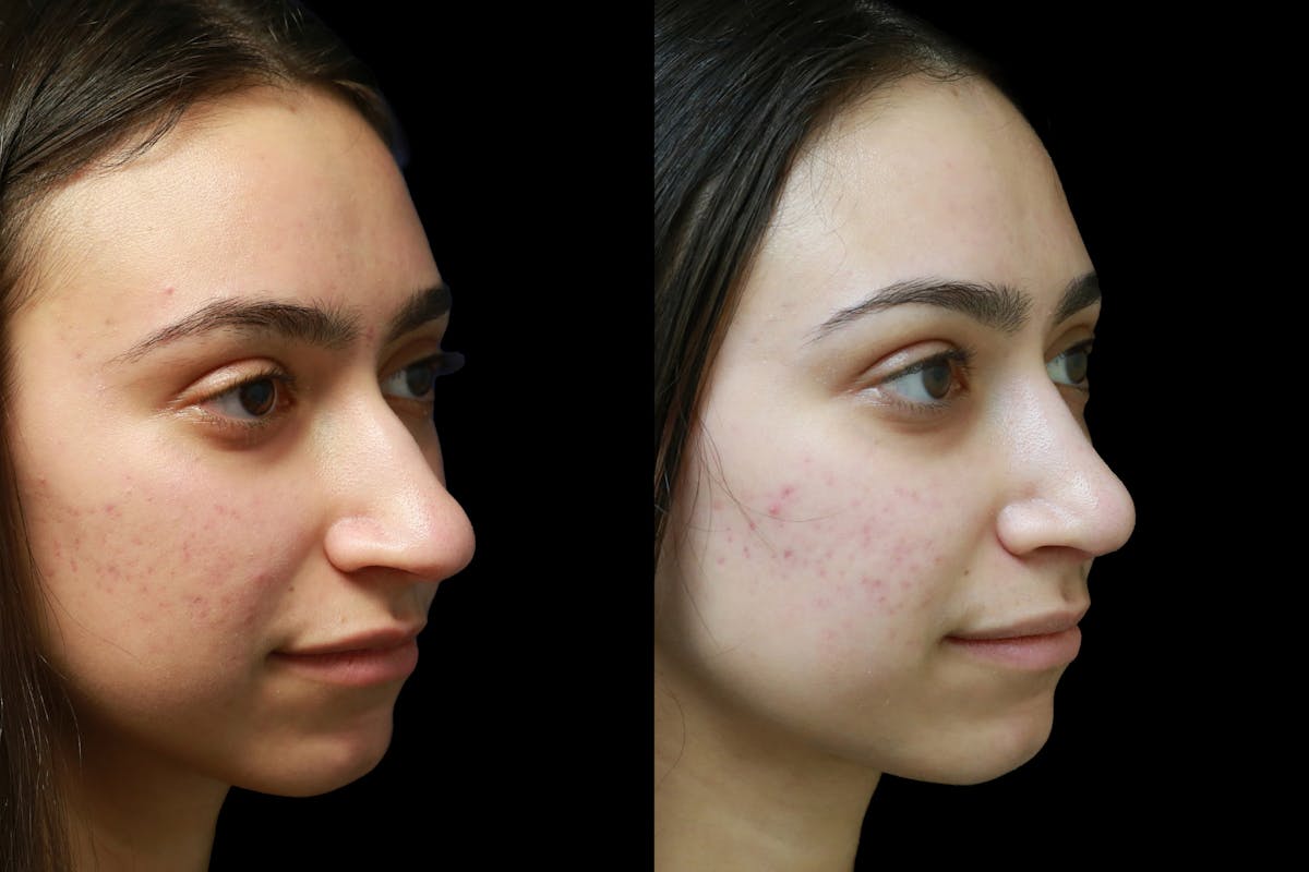 Rhinoplasty Before & After Gallery - Patient 317097 - Image 2