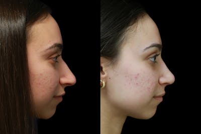 Rhinoplasty Before & After Gallery - Patient 317097 - Image 1