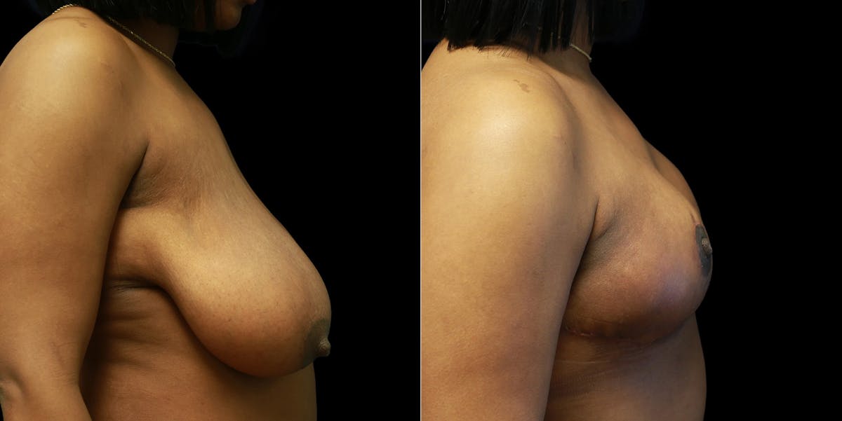 Breast Reduction Before & After Gallery - Patient 356790 - Image 3