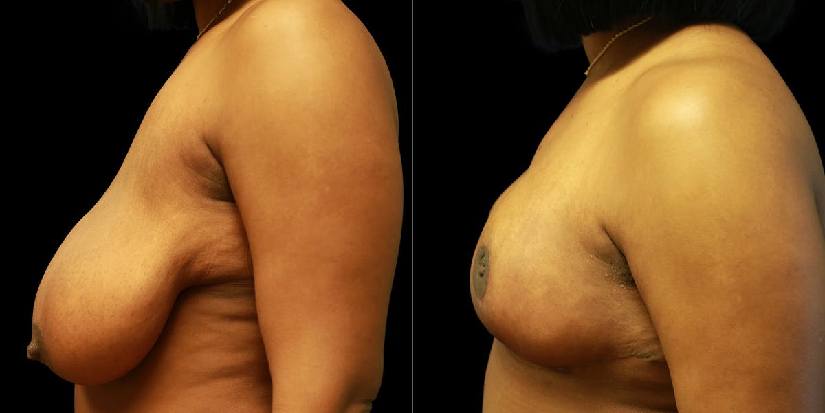 Breast Reduction Before & After Gallery - Patient 356790 - Image 5